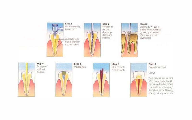 dapto-root-canal