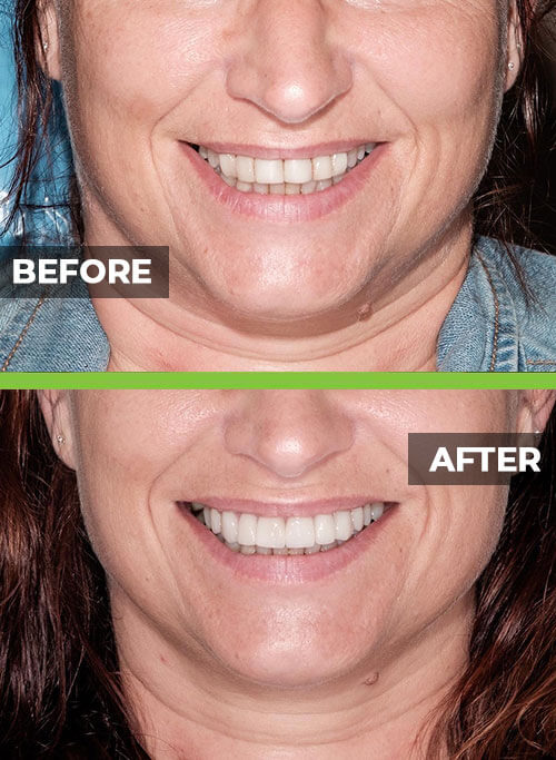 before-after-veneers1.jpg