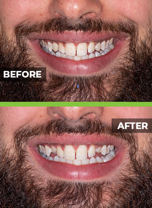 before-after-veneers4.jpg